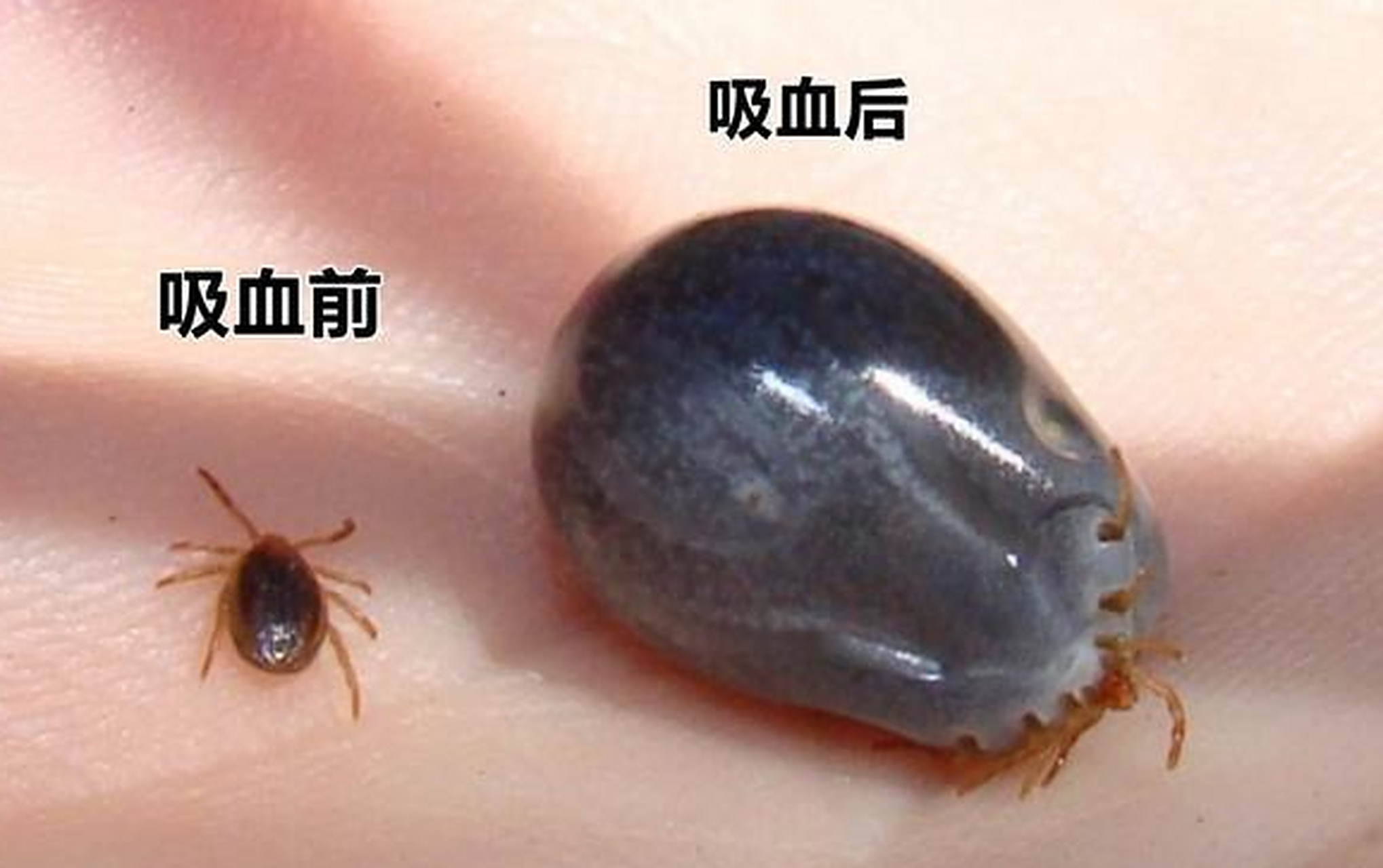 一位七十岁老太被蜱虫叮咬后,不幸离开了人世,同时