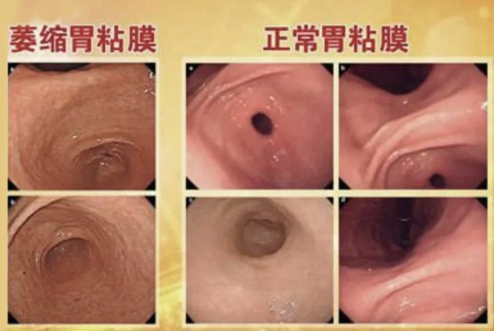 什么是慢性萎缩性胃炎?