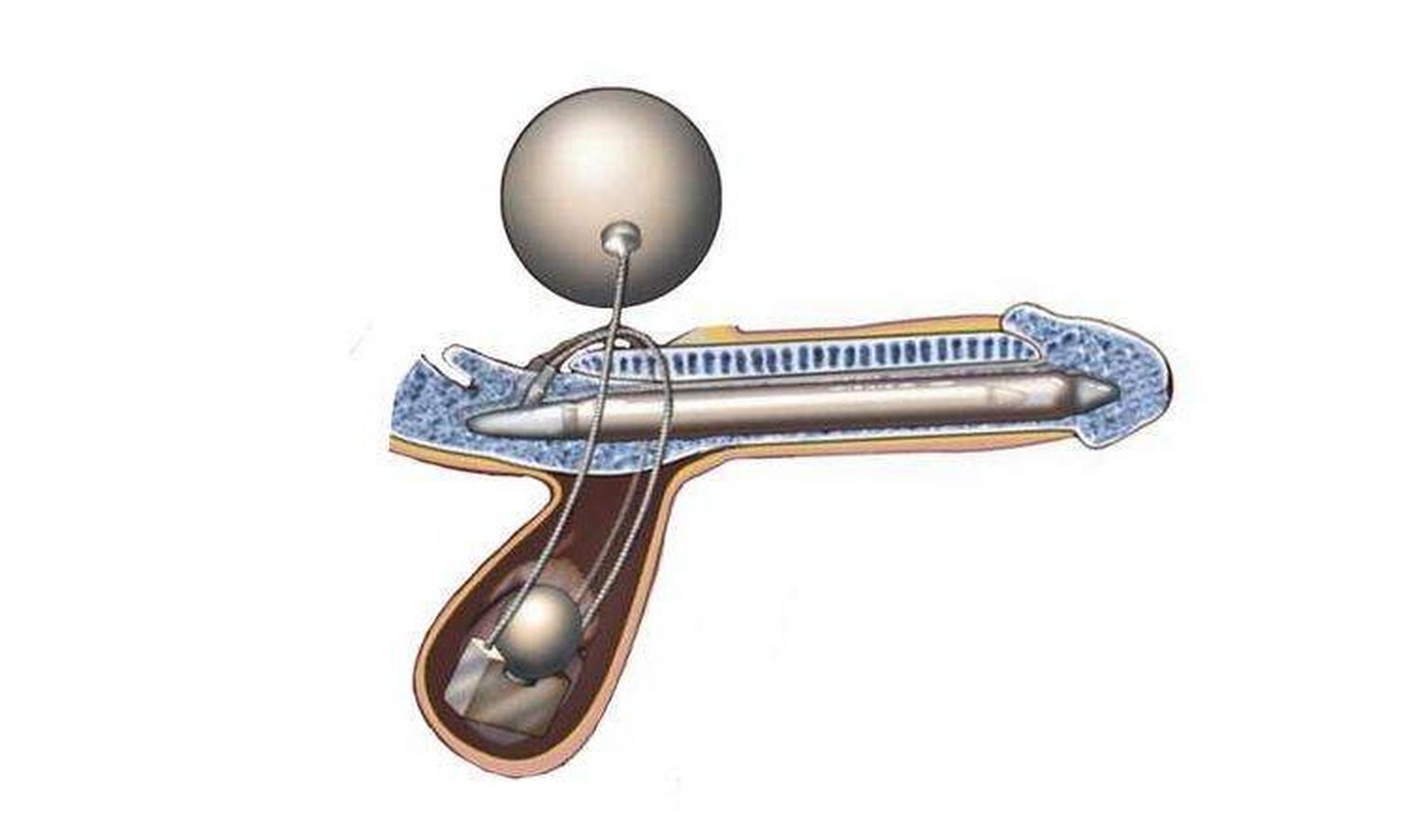 假体手术后阴茎的勃起是通过假体来控制的勃起,那么感觉上基本不挥行
