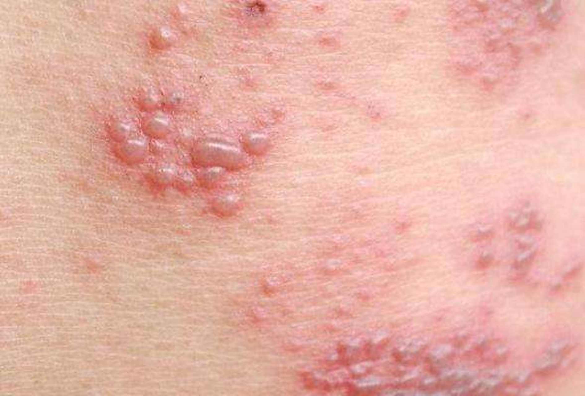 疱疹是由水痘-带状疱疹病毒感染引起,感染的过程中就会引发一系列症状