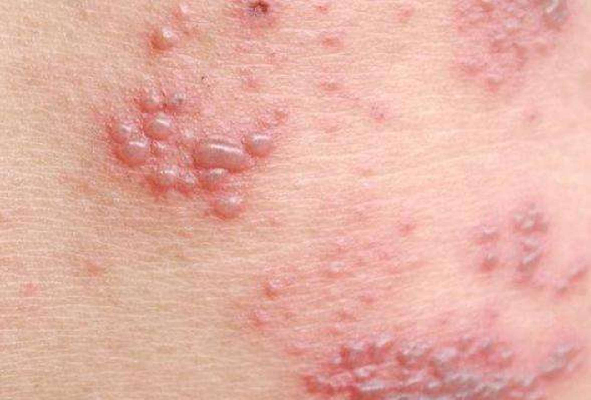 蛇缠腰# #赣州皮肤病医院# 蛇缠腰又称为带状疱疹.