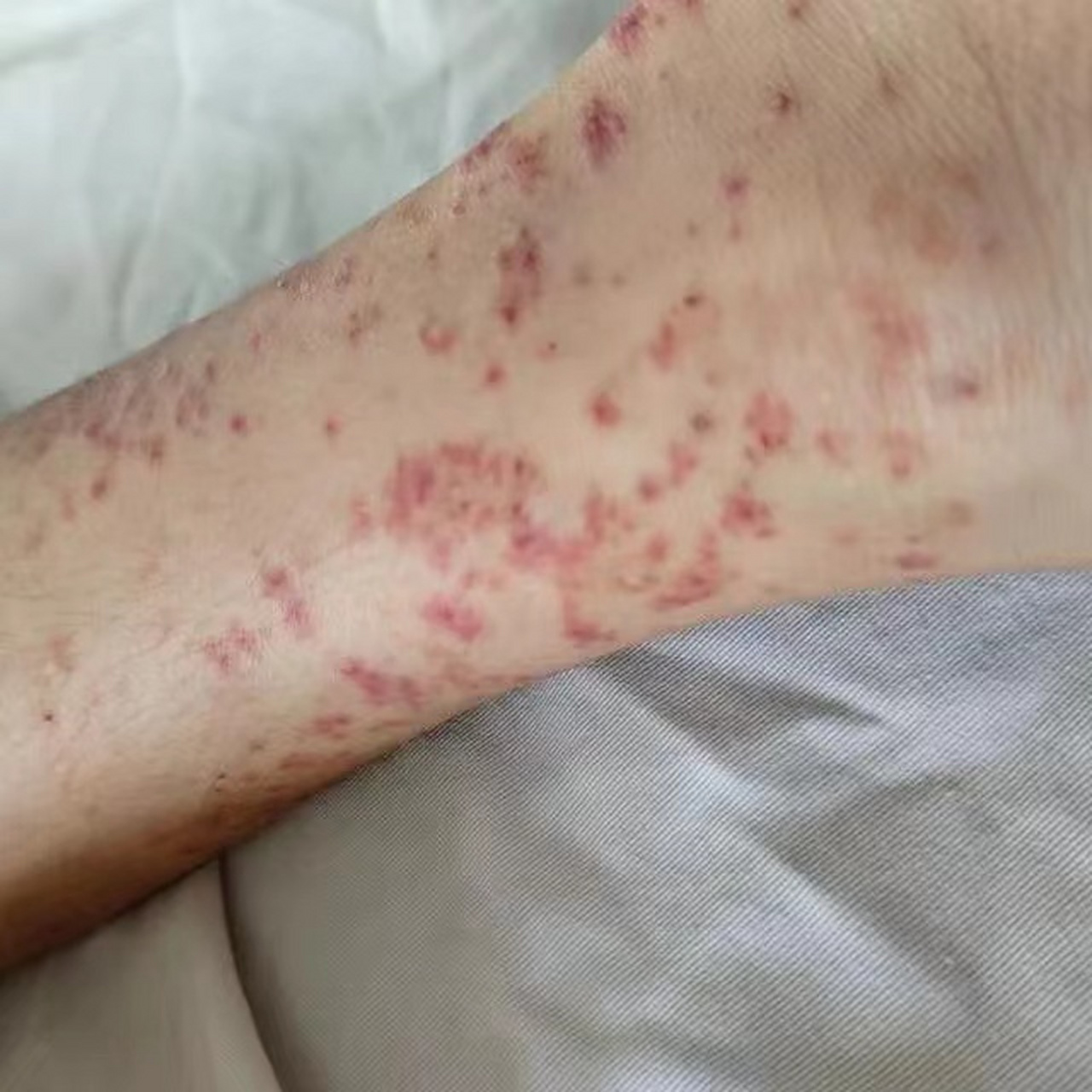 儿童特发性血小板减少性紫癜,出血有4个等级: 一级:少量出血,紫癫