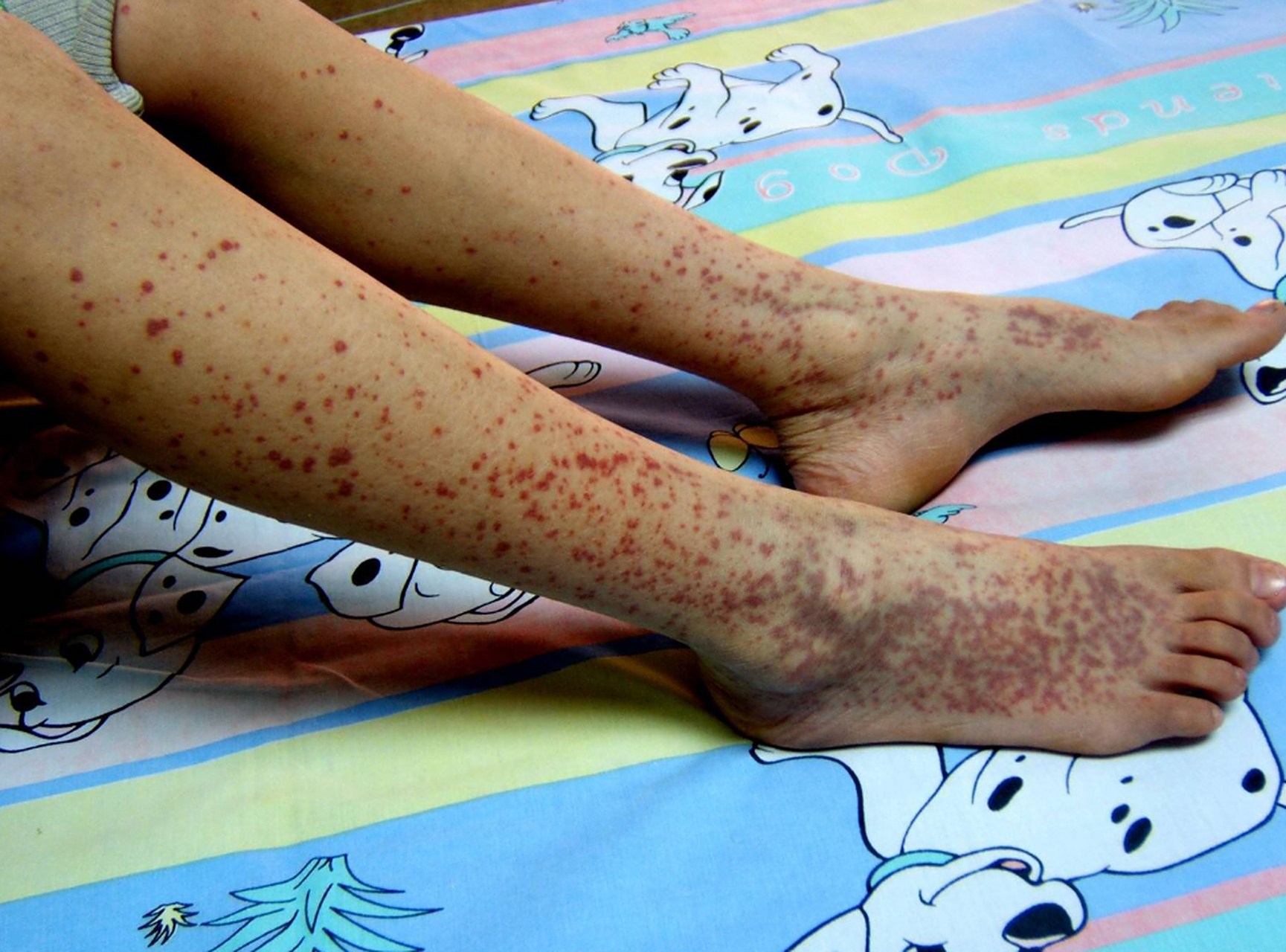 过敏性紫癜可以完全治愈吗?