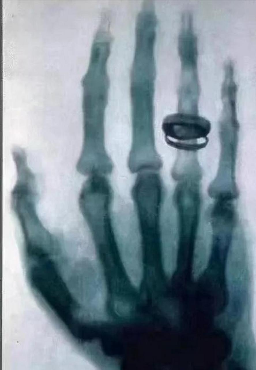 百家号星火计划# 威廉·康拉德·伦琴发明x光射线4天后,就在临床实践