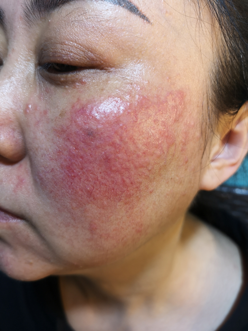 你们一定觉得没有任何方法或者产品来改善,毕竟大家有了这种皮肤后,真