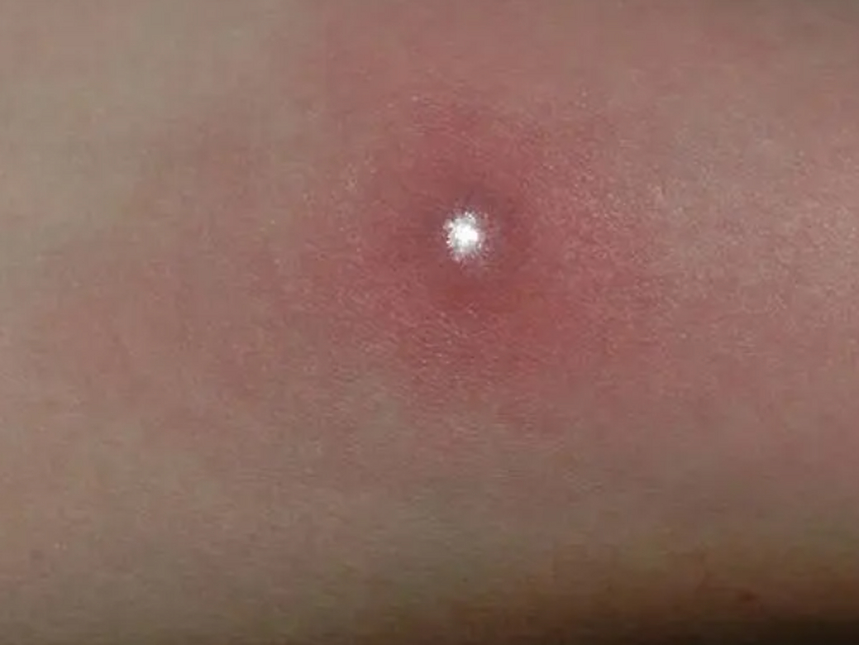 屁股上怎么也会长痘呢?小周咨询医生道.