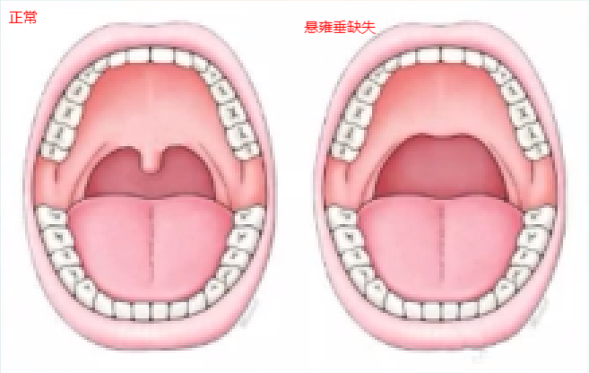 悬雍垂正常的样子图片