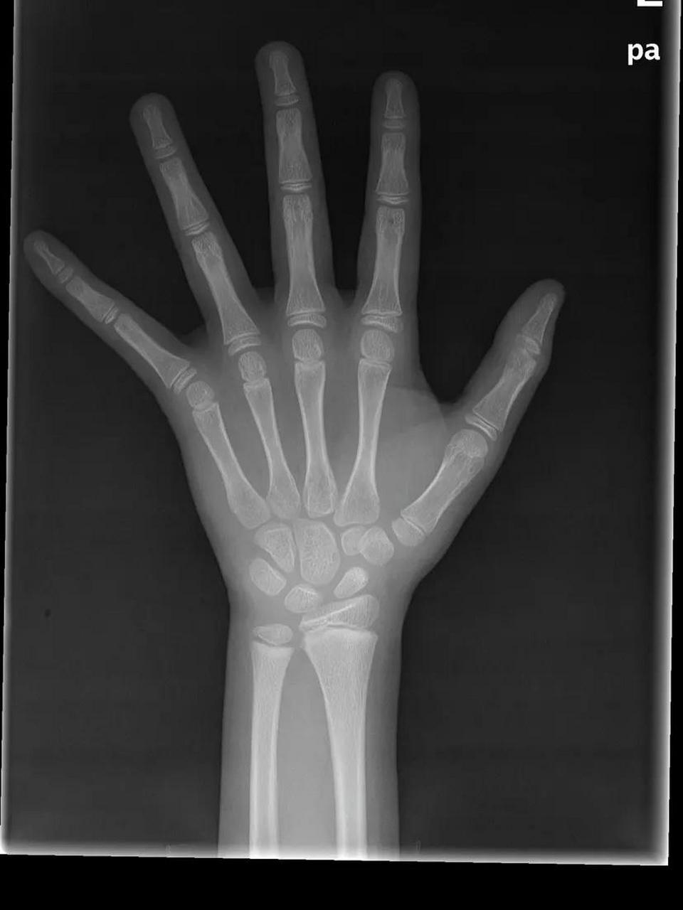 9岁女孩,长得慢长得矮,不打针,如何高效追高?