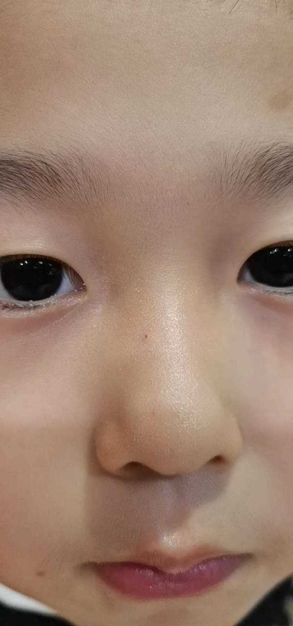 昨天小孩放学,吃饭时我发现儿子鼻子上面有个小洞,像是被什么东西给扎