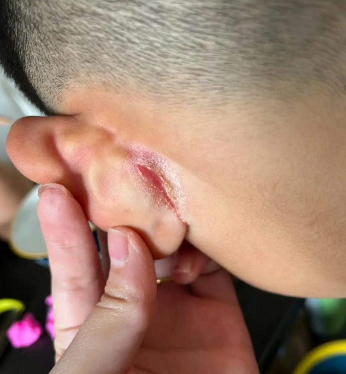 小孩子,耳朵后面烂了,该怎么治疗,愁人啊!