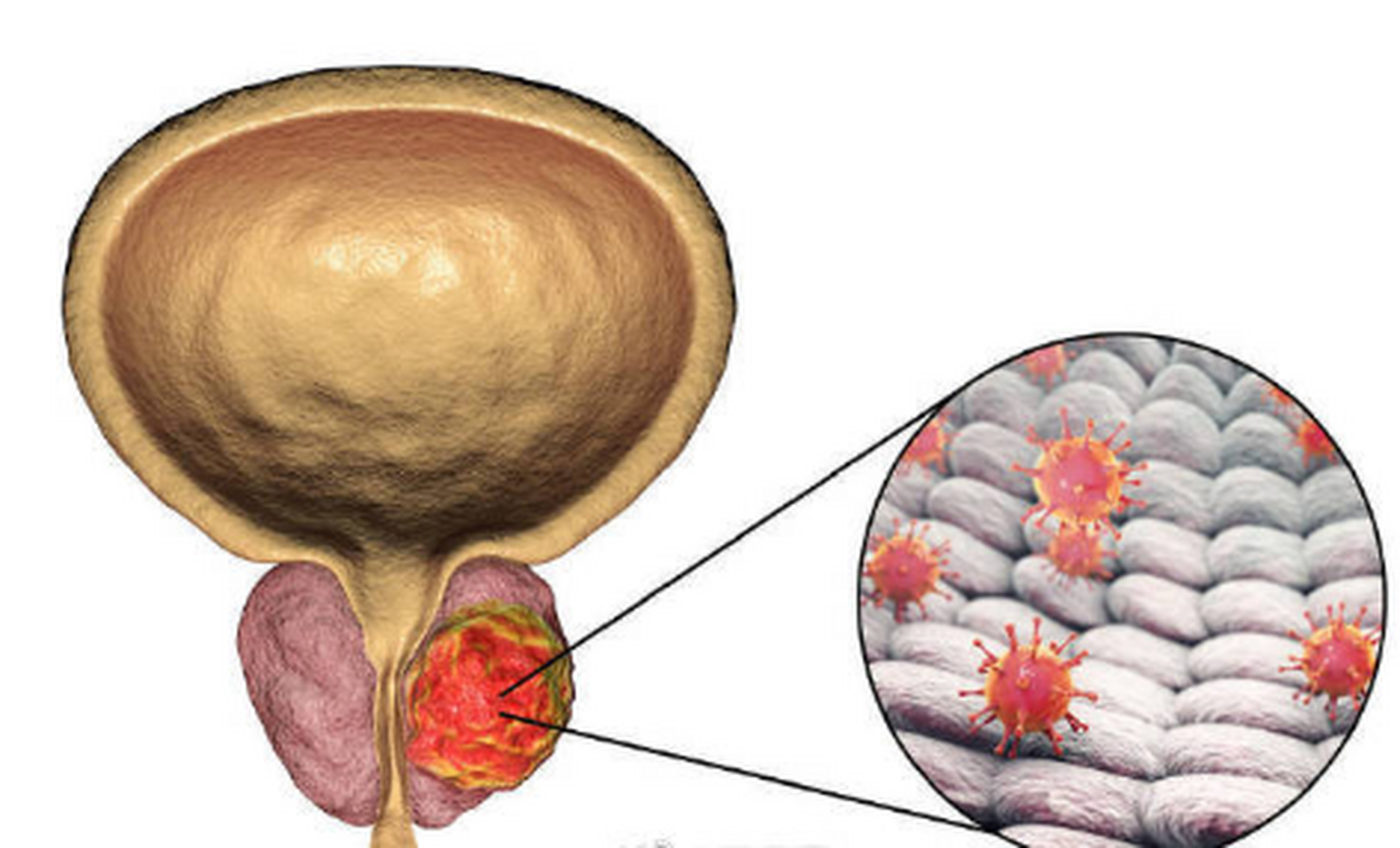 前列腺钙化是怎么发生的?它有什么表现?出现这种问题怎么办?