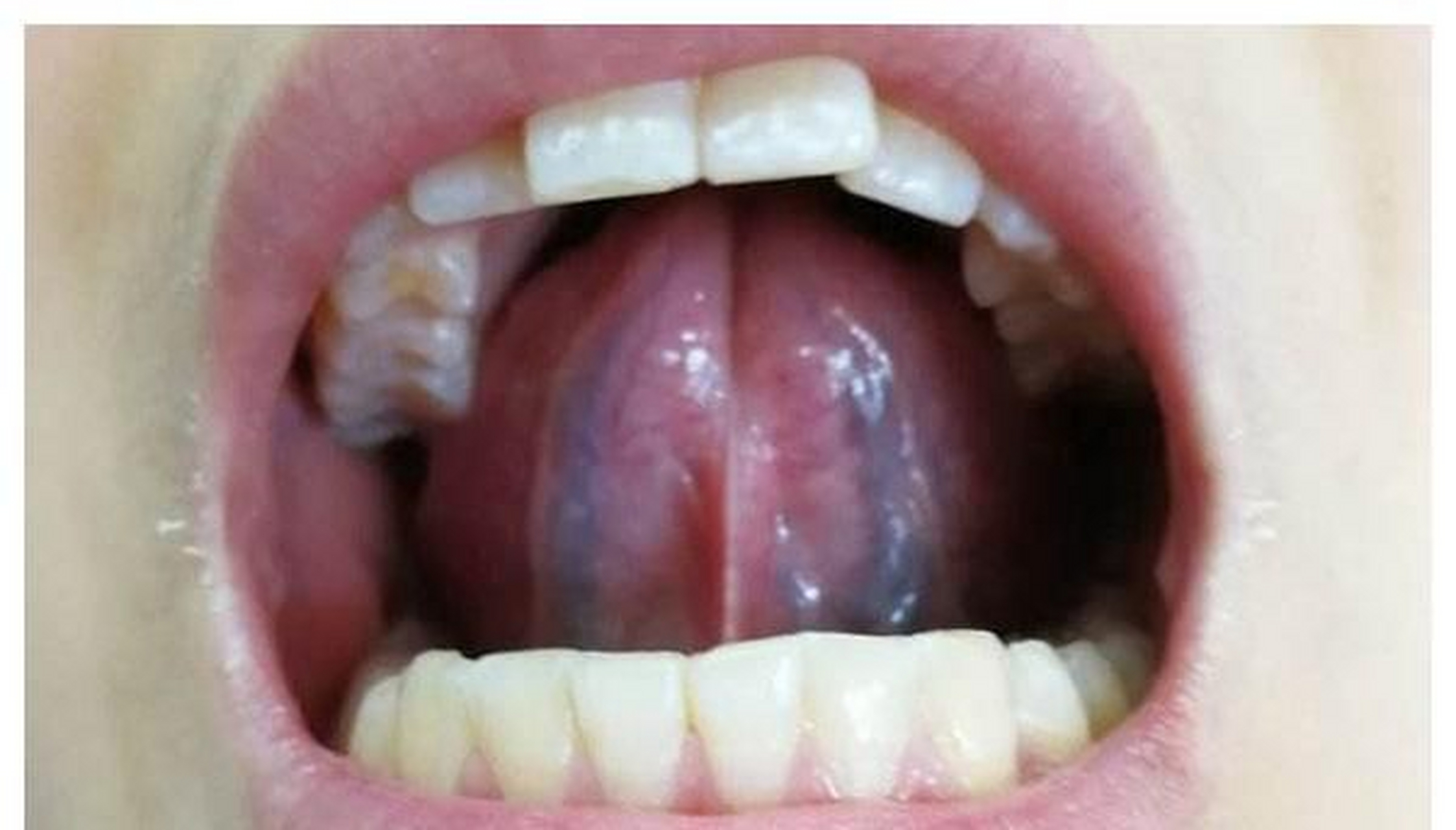 舌下青筋血瘀是哪里淤图片