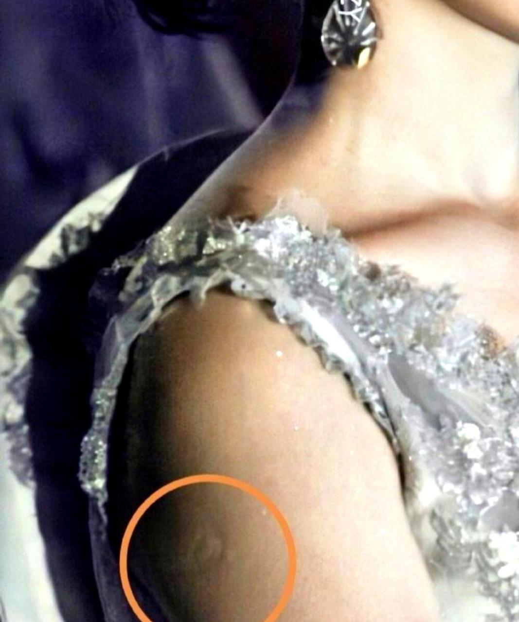 这是卡介苗接种后留下的疤痕,但我不知道为什么我没有留下那个疤痕.