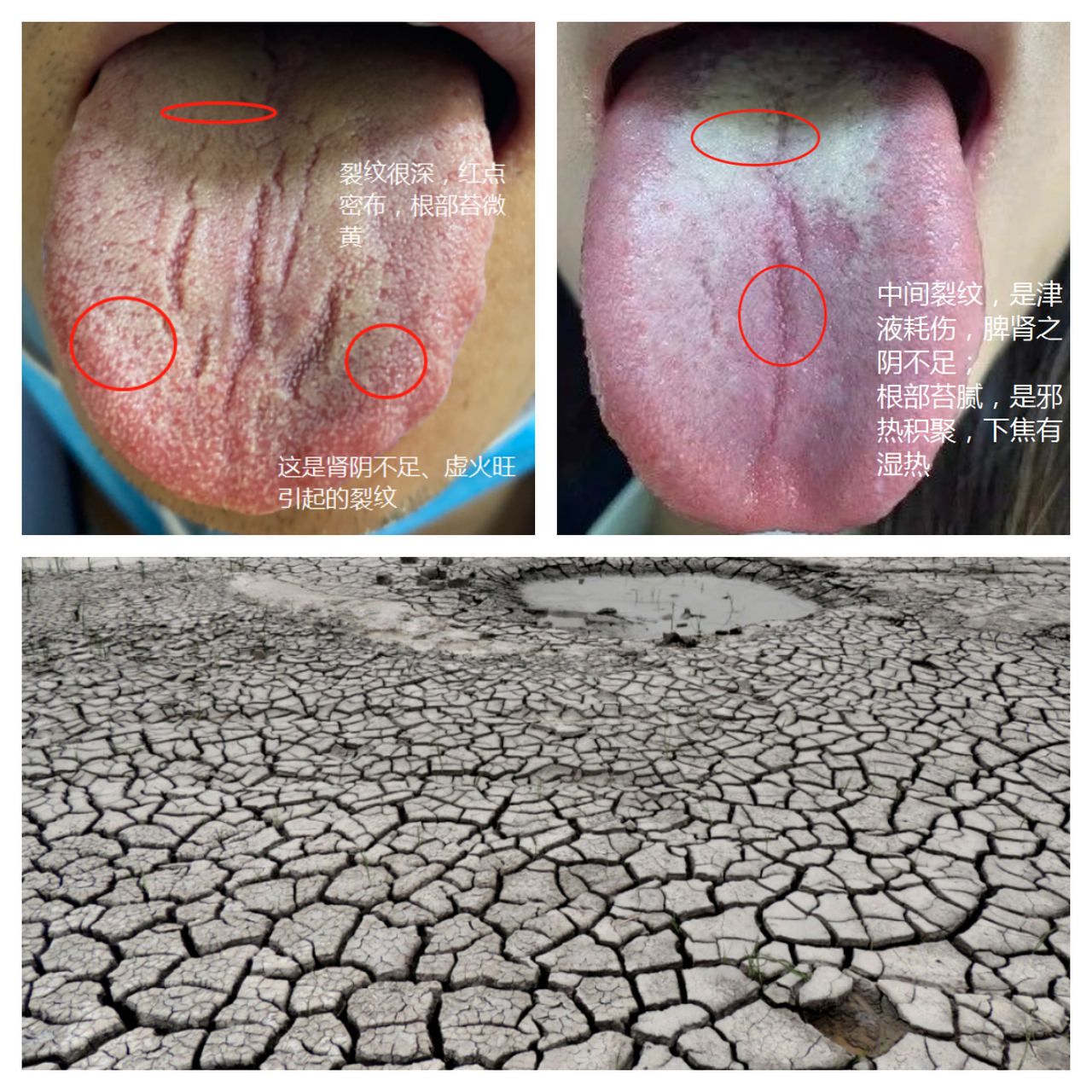 舌苔有裂纹,这个和大地开裂有联系 裂纹舌比较好理解,大地龟裂之象.