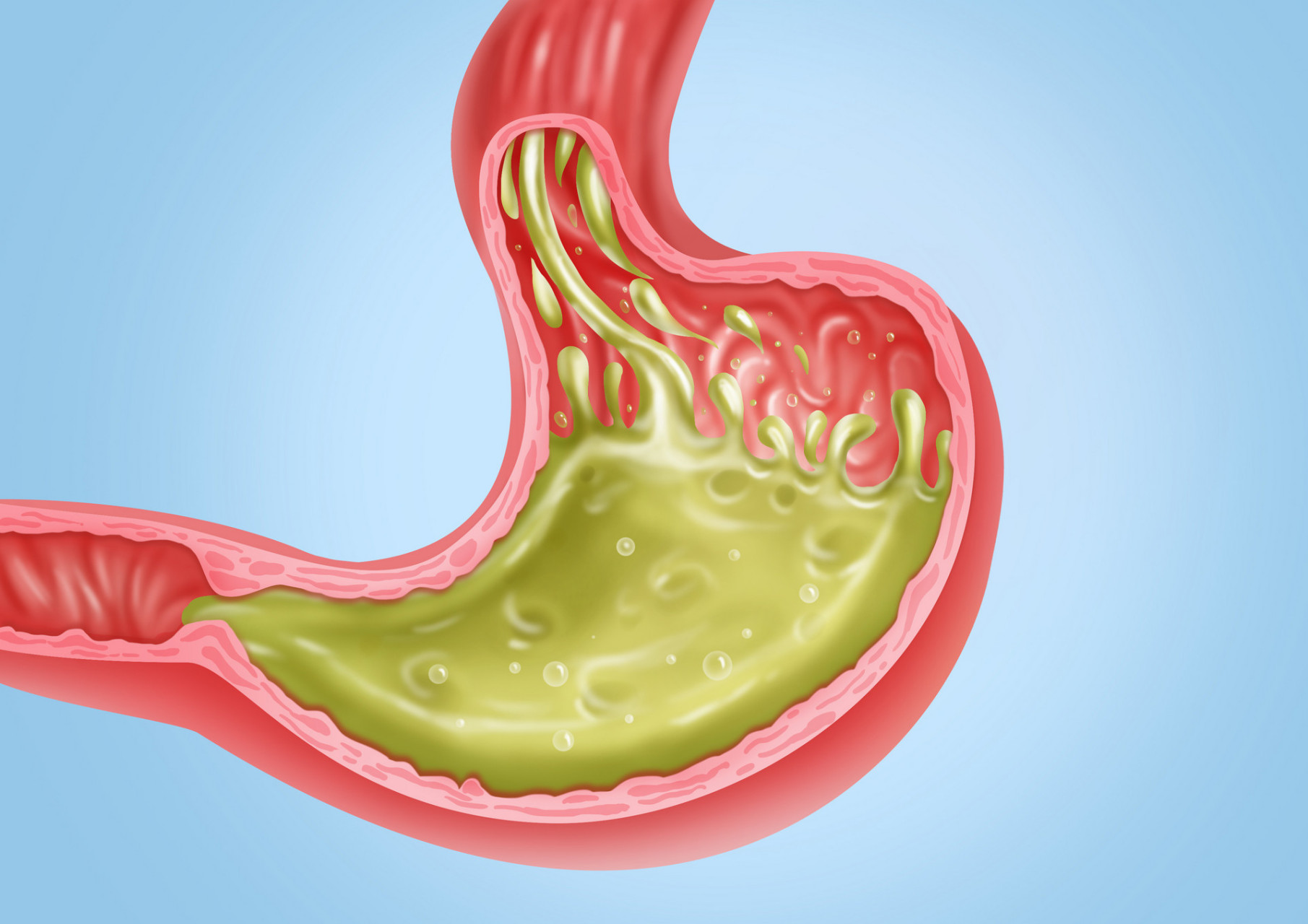 正常情况下,胃酸应该在胃内消化食物,但有时胃酸会逆流到食道,导致不