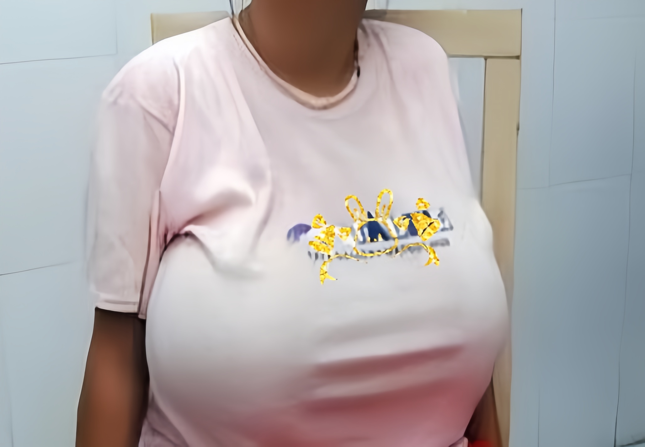 胸大也会有烦恼?可能是病,得治!