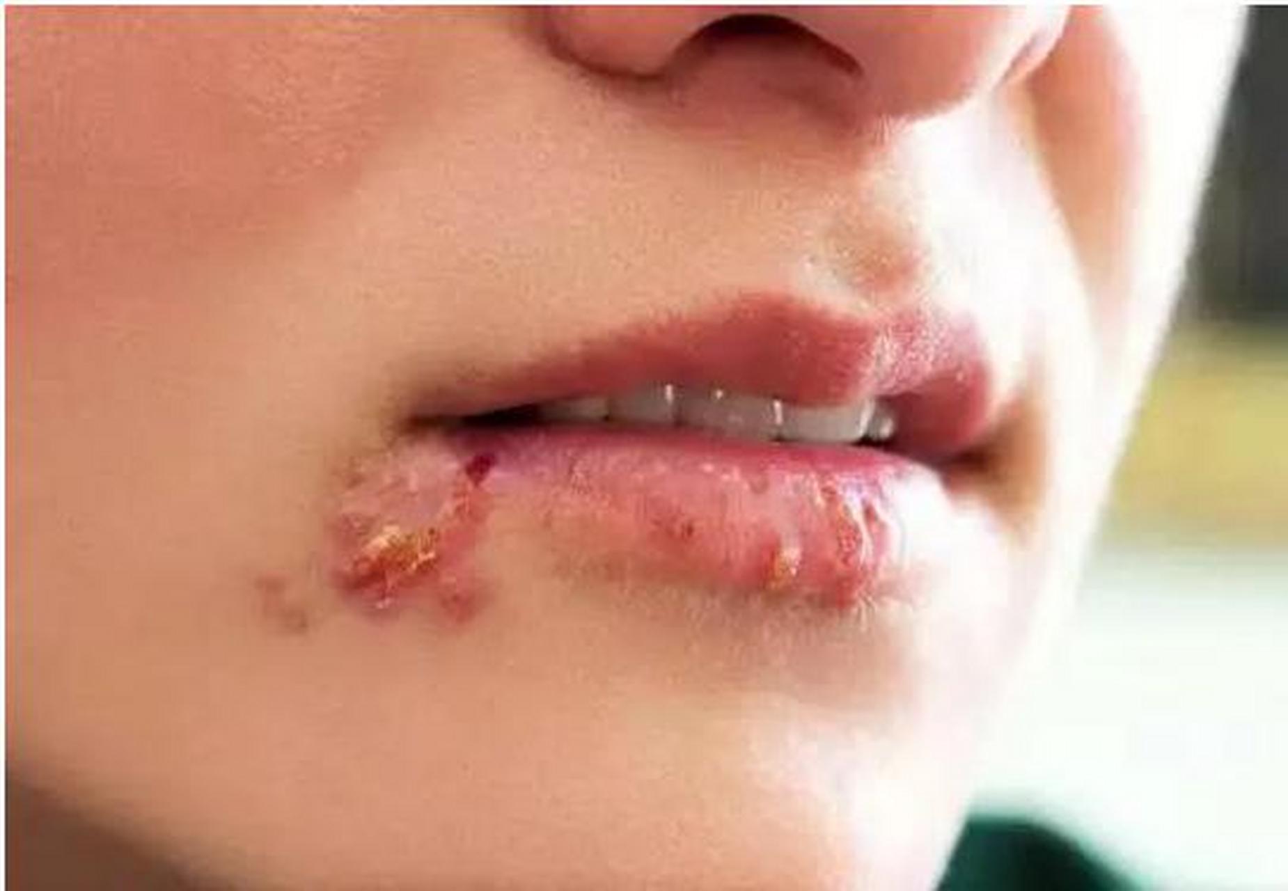 口唇疱疹是由单纯疱疹病毒(hsv)感染引起的,属于自限性疾病,一般7100