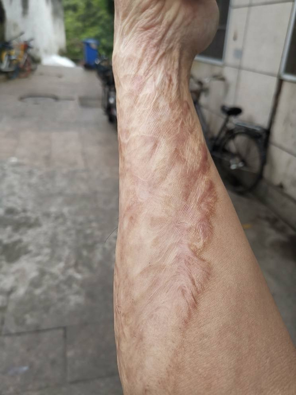 处理烫伤疤痕的最佳时间是在伤口完全愈合后开始,通常为烫伤后的2至