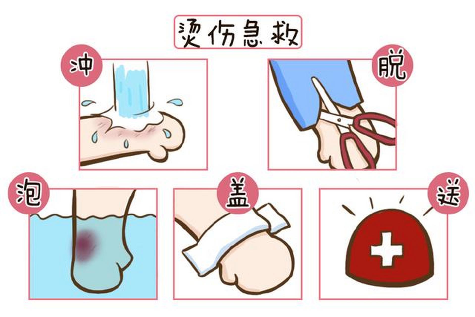 烧烫伤涂牙膏不可取,正确处理方法应该这样做!