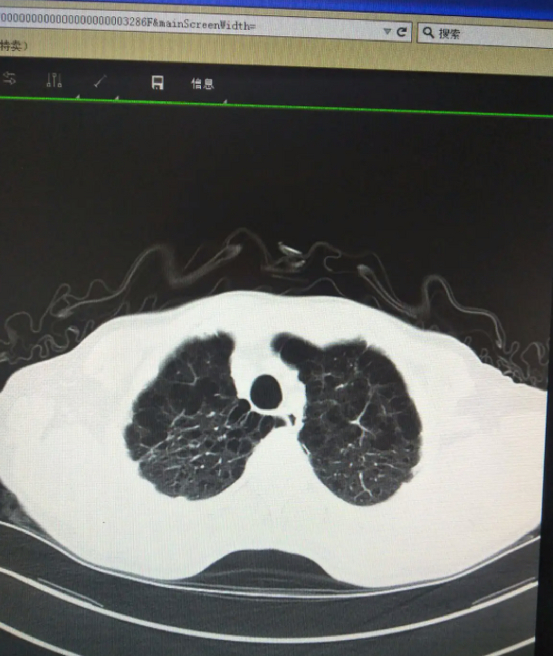 很多患者以为肺大泡就是肺气肿,其实它们在本质上是两种病症,肺大 