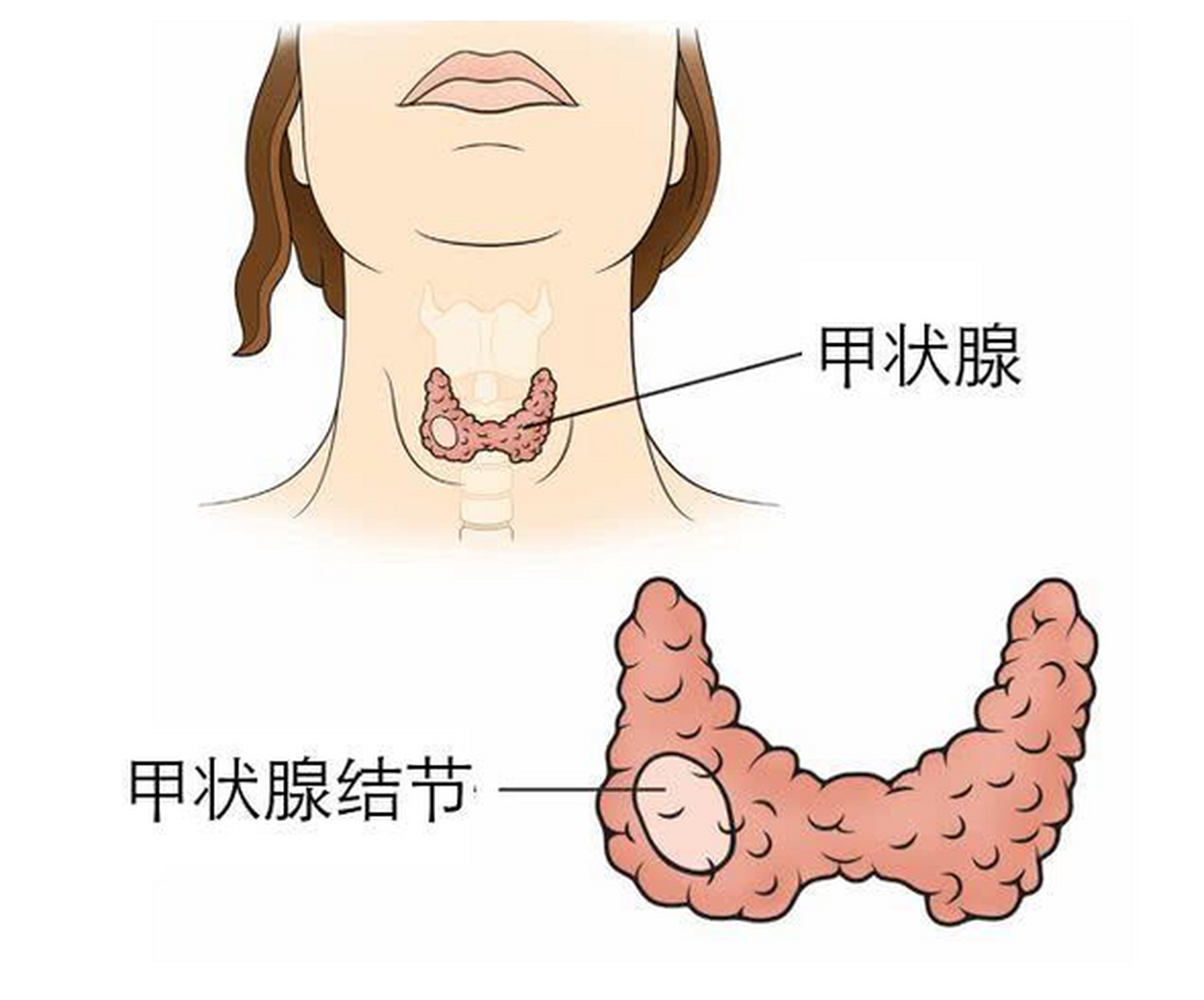 [73]甲狀腺結節多少釐米為正常 [73]甲狀腺是3cm左右大小的器官