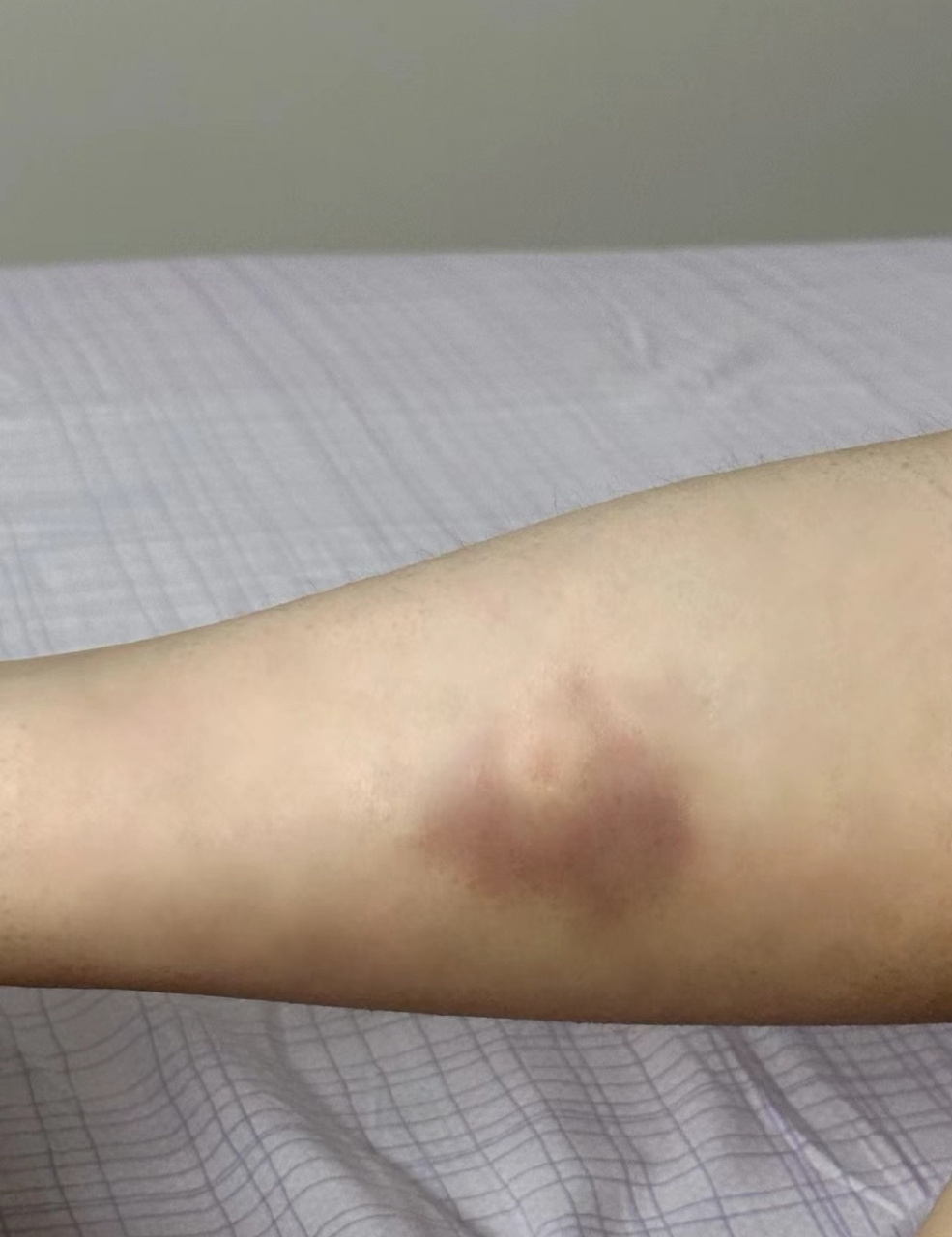 蚊子把我腿上的淤血吸走了