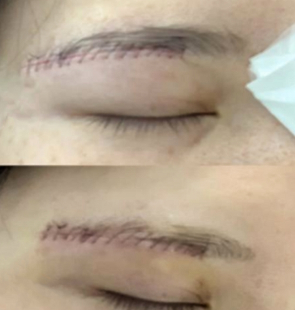 很多人做了#提眉手术# ,那么你们知道手术失败是怎么样的吗?