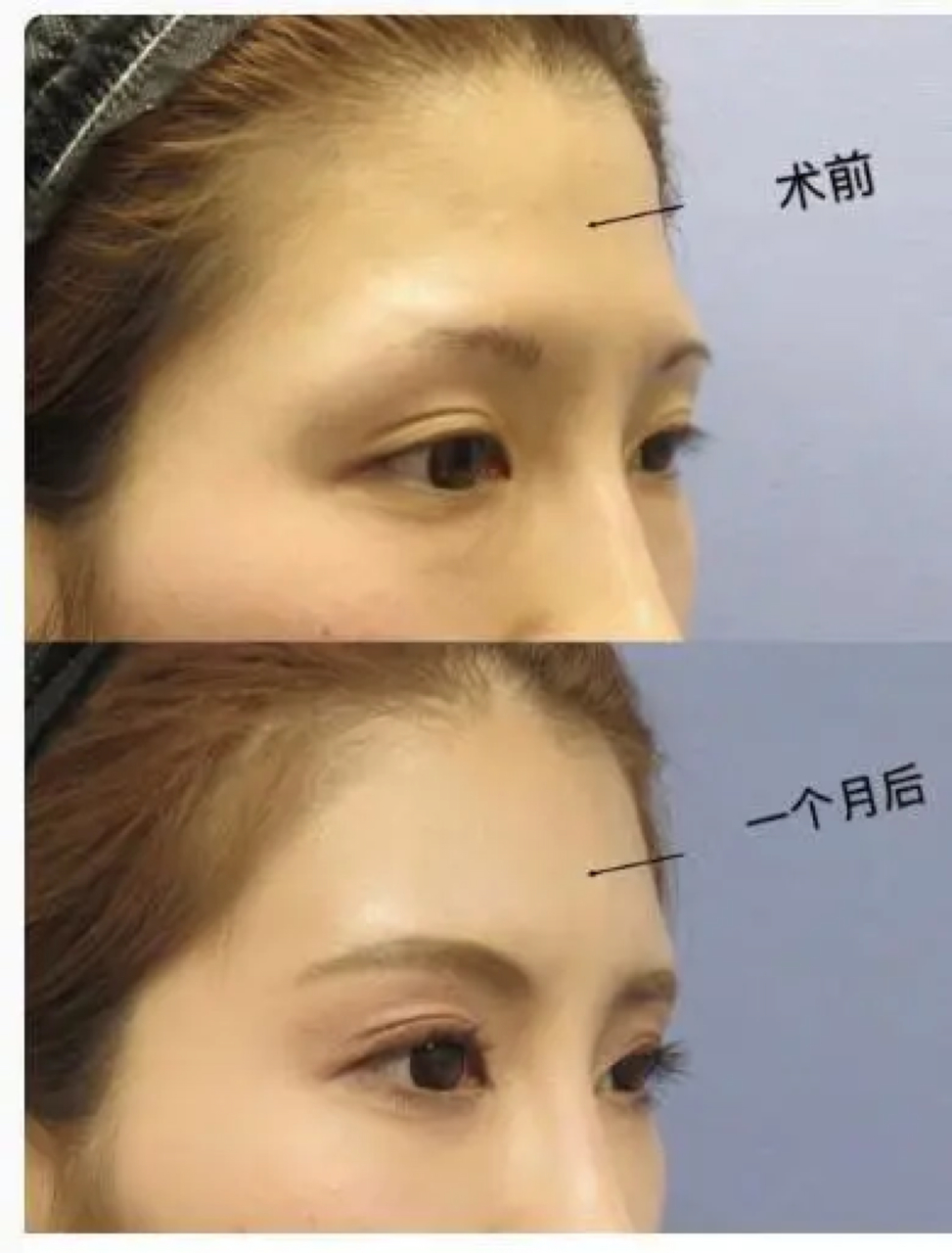 朋友打完玻尿酸,额头中间突然有一个凹陷?