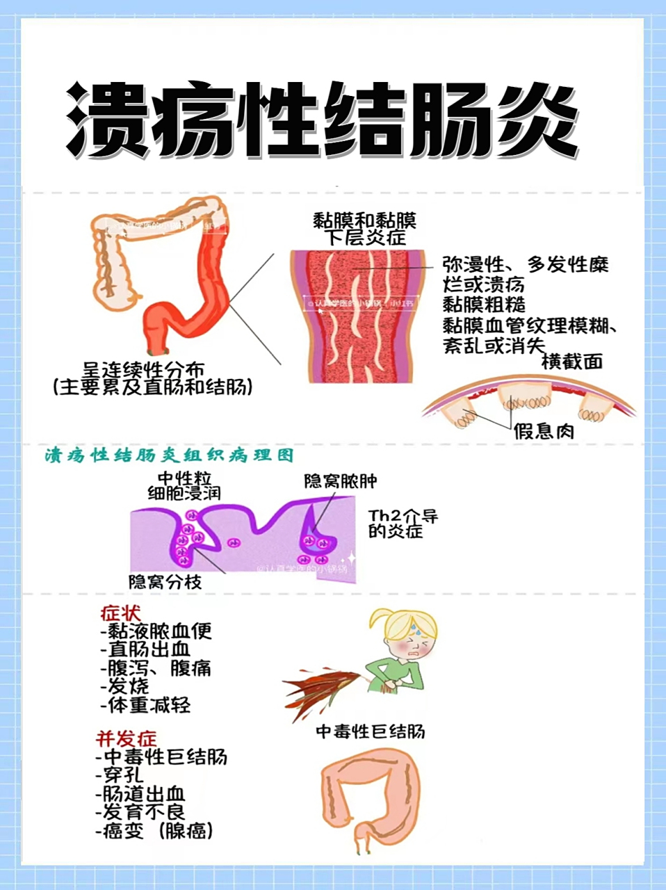 【症状多,注意区分】 溃疡性结肠炎是一种慢性肠道疾病,症状多种