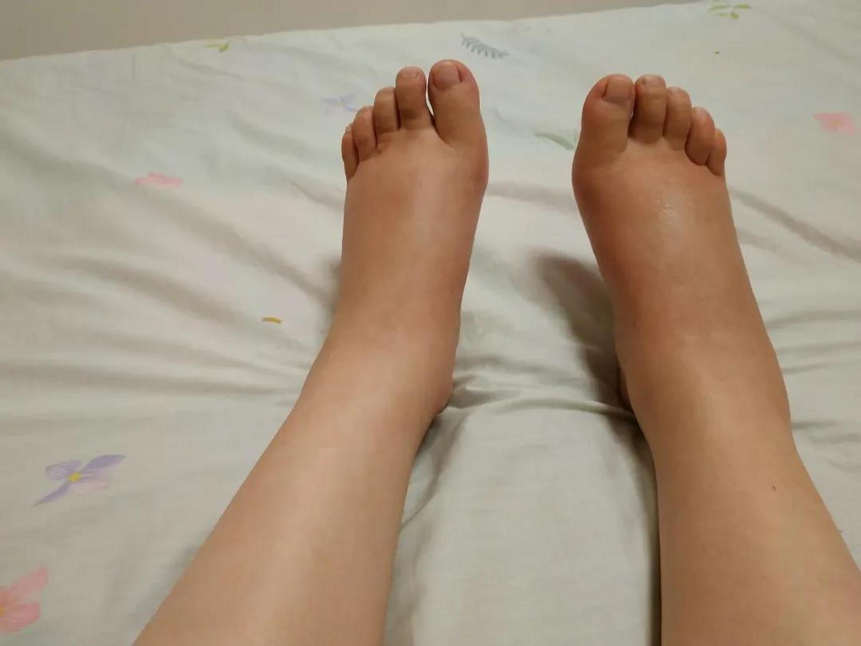 红斑狼疮腿肿是怎么回事?