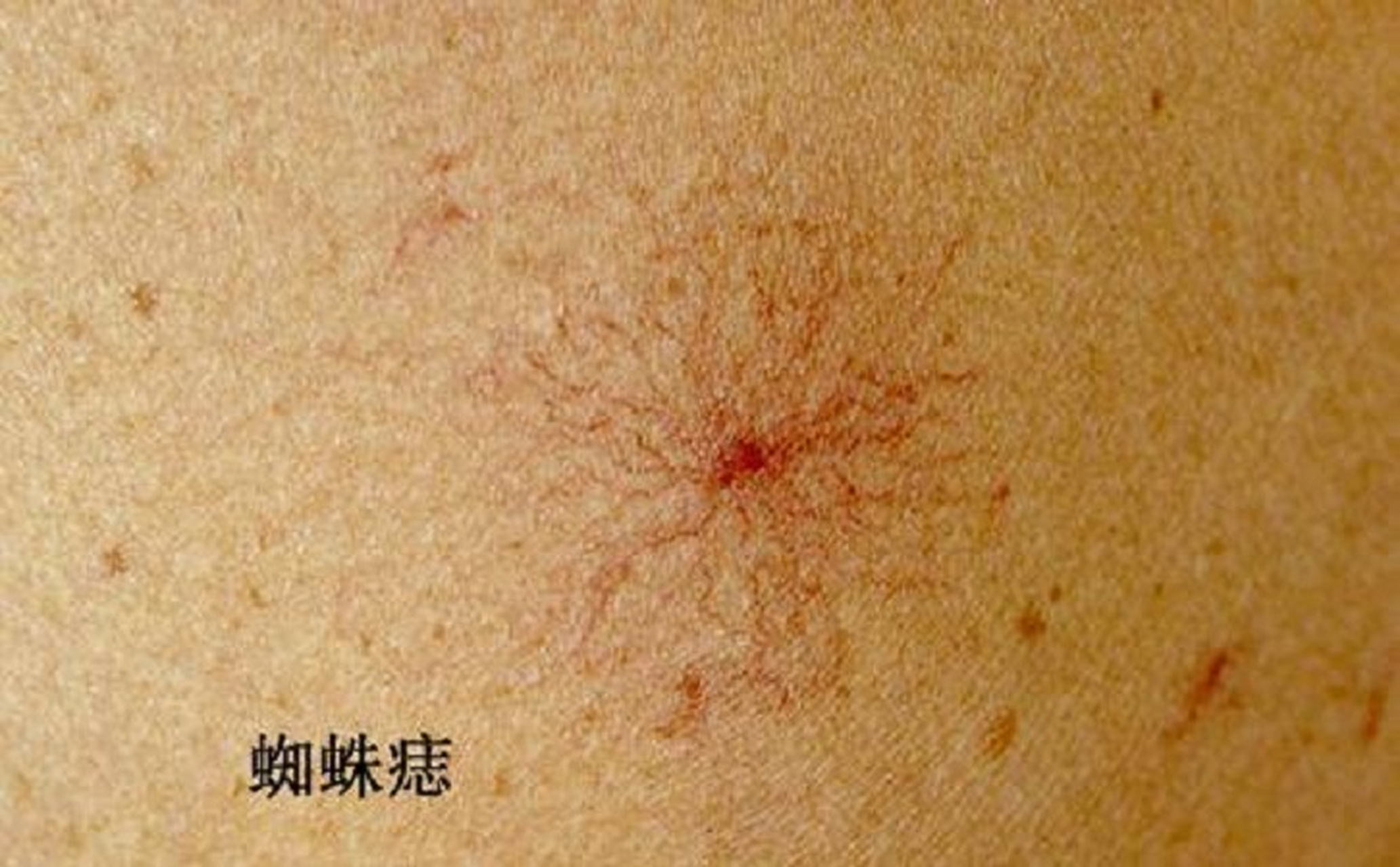 肝癌患者有时候会长一种蜘蛛痣的东西,这种蜘蛛痣是什么样的?
