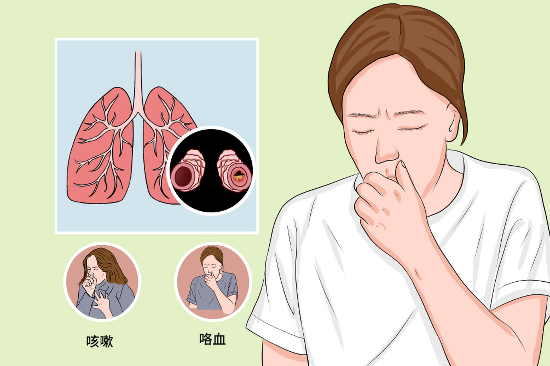 支气管扩张痰中带血?