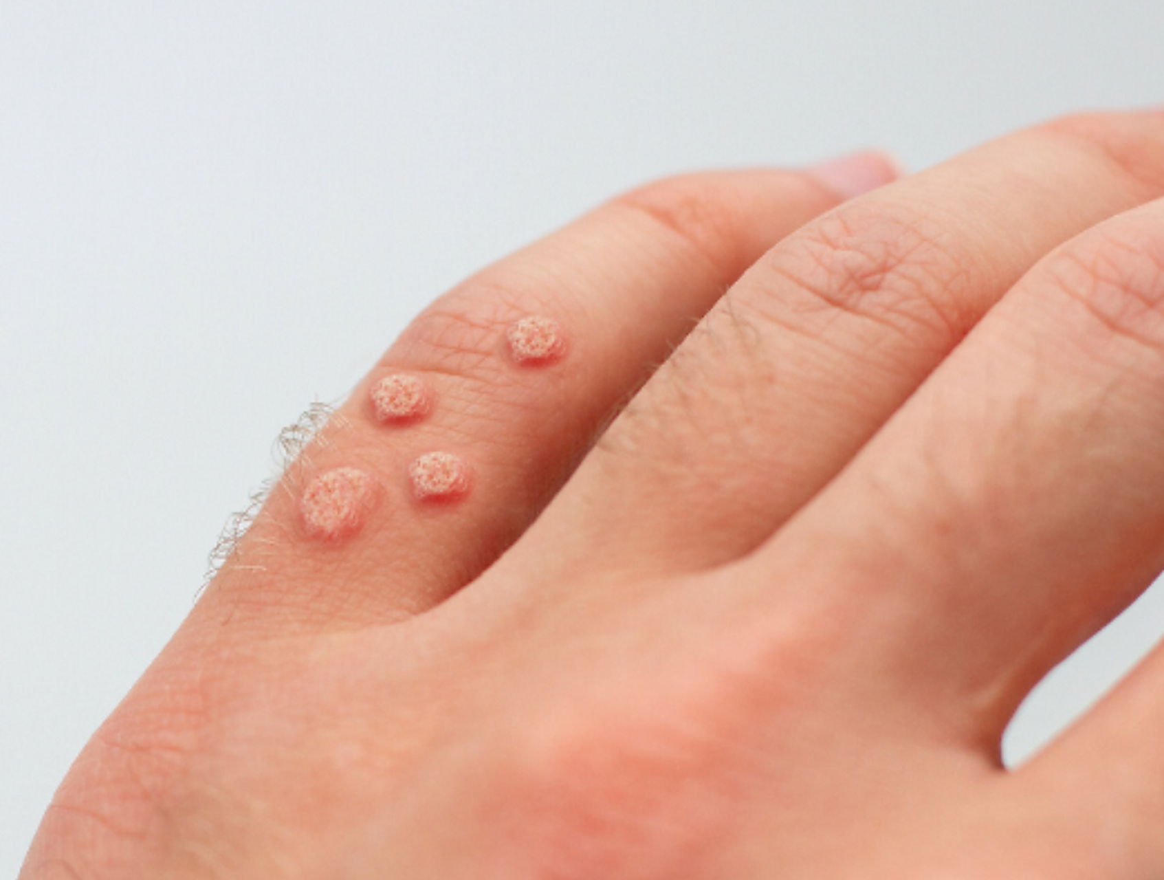 去就近的医院皮肤科就诊,让医生仔细检查并给出专业的诊断和治疗建议