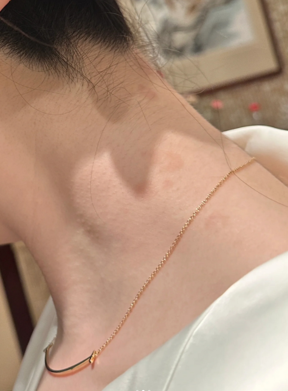 脖子上出现咖啡斑是我多年以来的困扰.