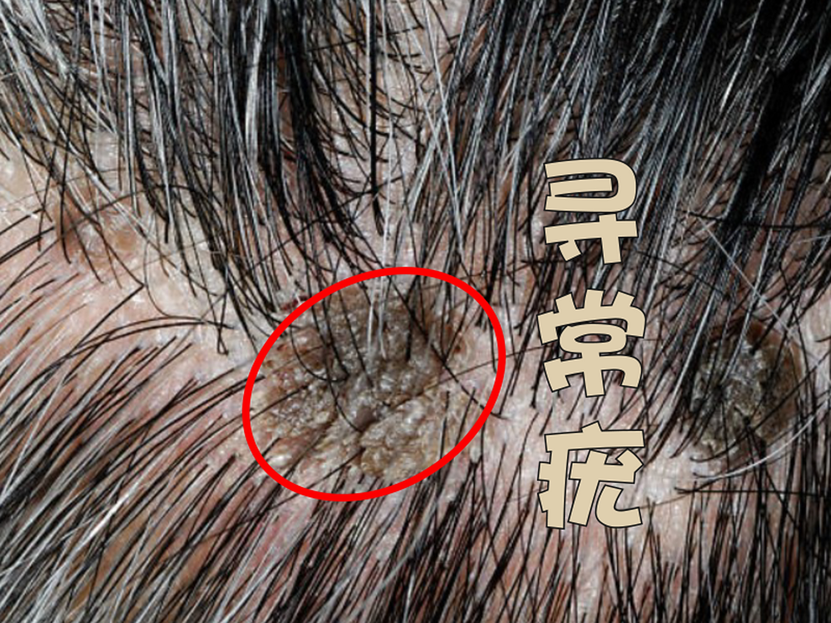 头上冒出寻常疣,怎么办?朱医生教你科学对待!