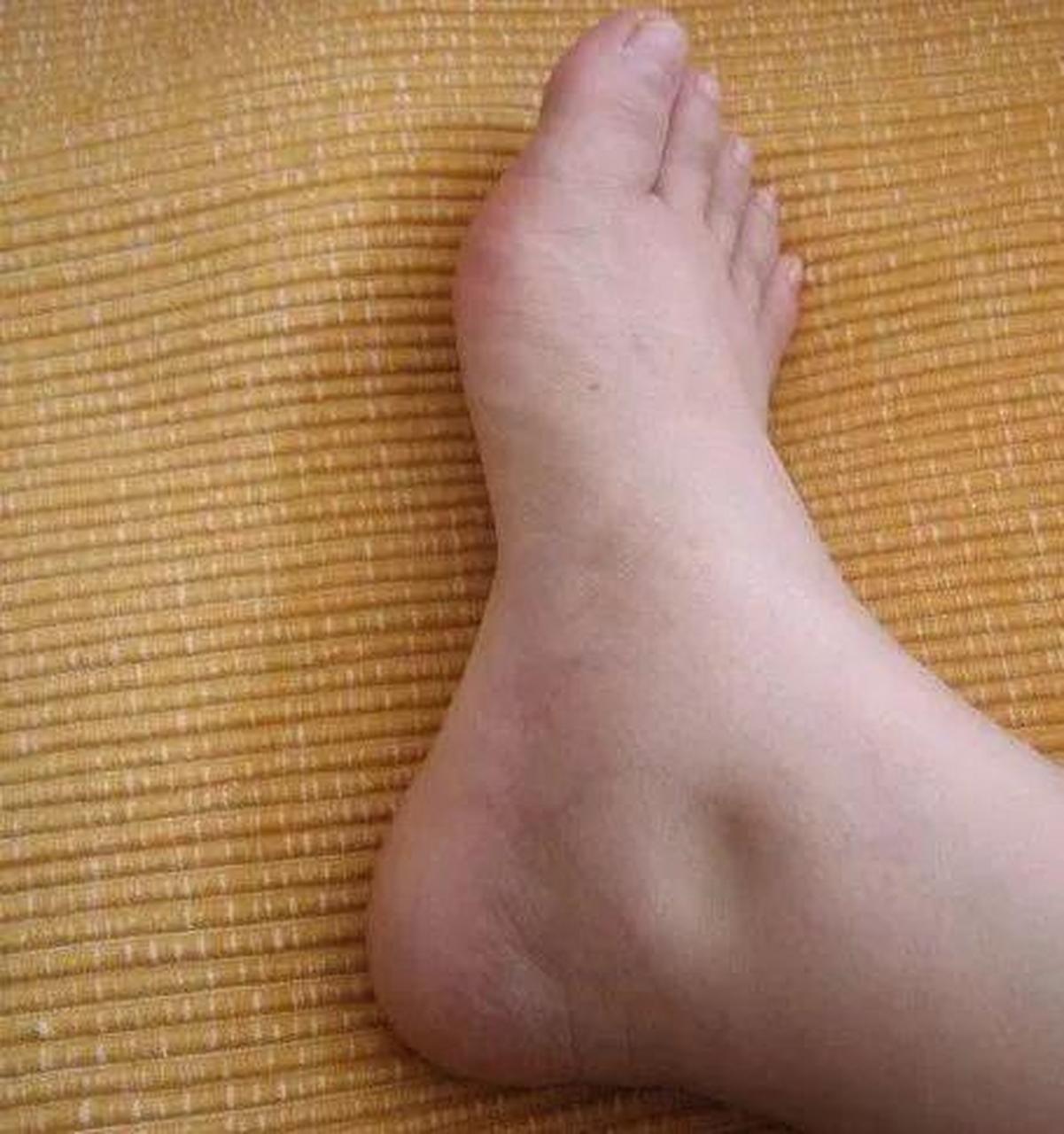 14岁的小志是一名初中学生,该患儿于去年9月底因颜面及双下肢水肿