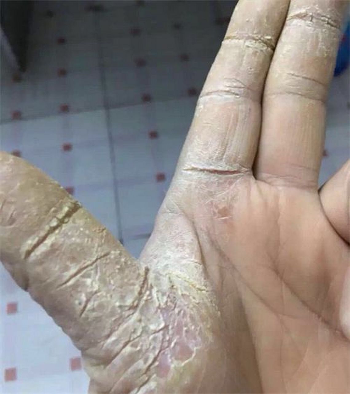 剥脱性角质松懈症,一开始会有小水泡,水疱干了之后手脚脱皮,不痛不痒.