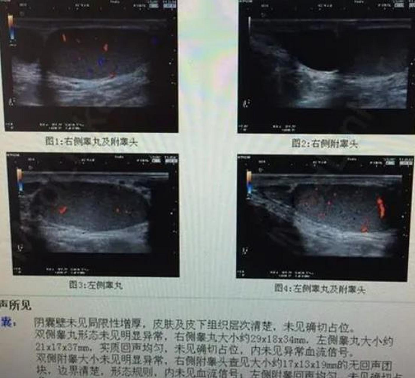 "昨天我跟妻子同房时,她突然说我睾丸那里有个小肉球,我们俩就暂时停