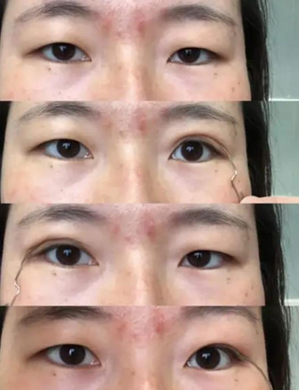 肿泡眼做双眼皮最大的一点就是一定不能做宽,要尽量的窄和自然.