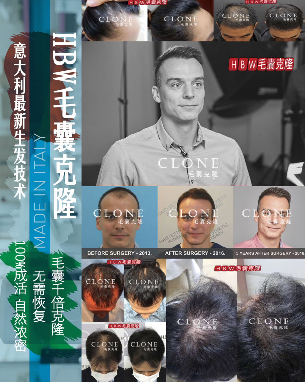 万众期待的hbw毛囊克隆技术,正式落地北京