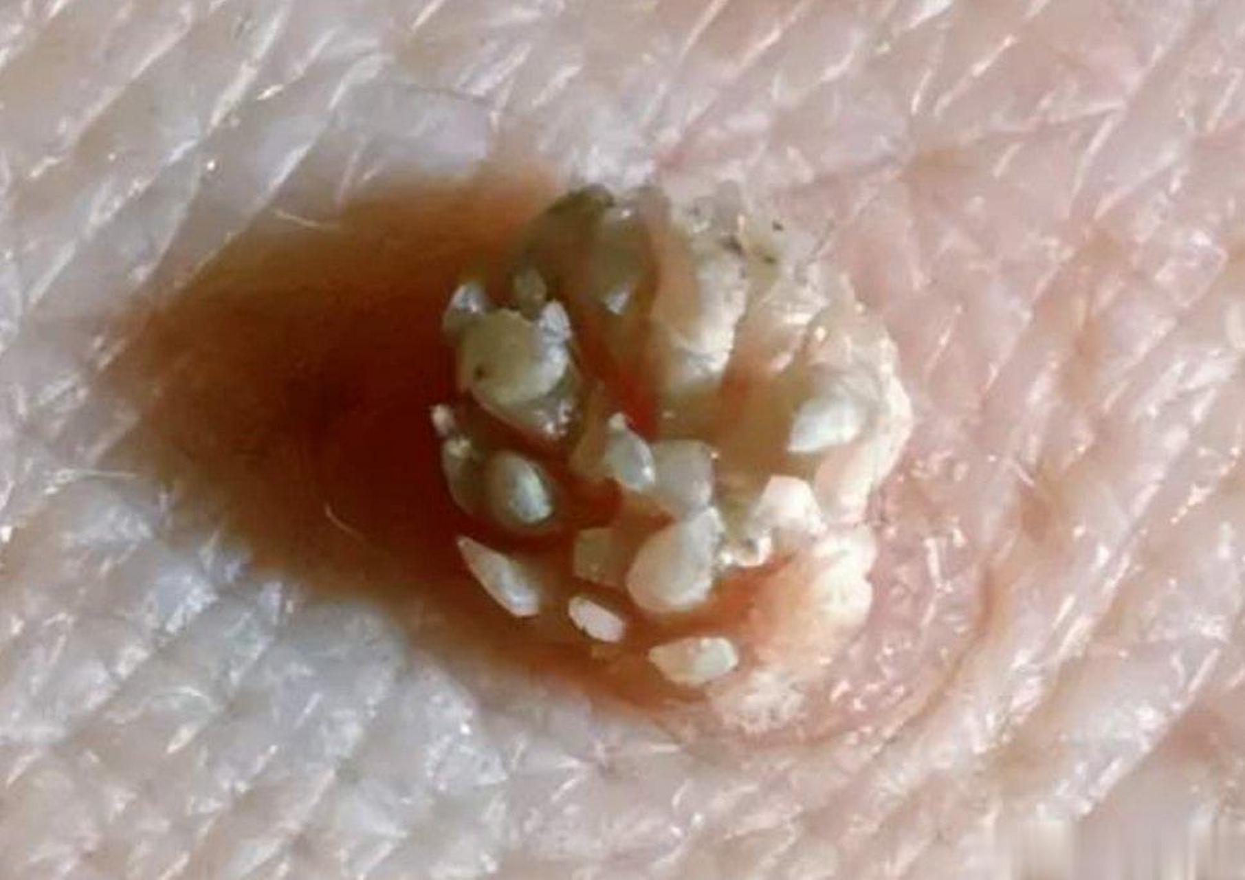 男童喉咙长菜花样肿块确诊感染hpv#前一阵一个男子jj上长菜花带着女