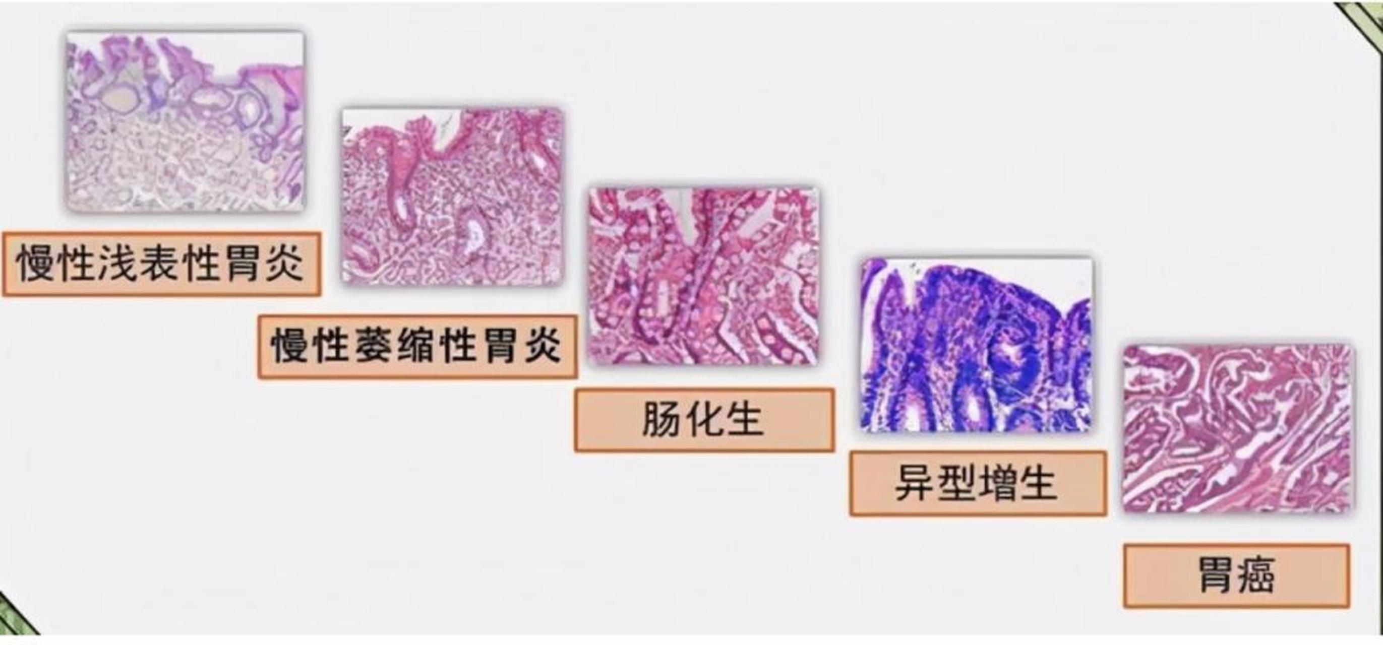 第一步,就是慢性浅表性胃炎,其实它是对胃损伤的初步反应,平时我们