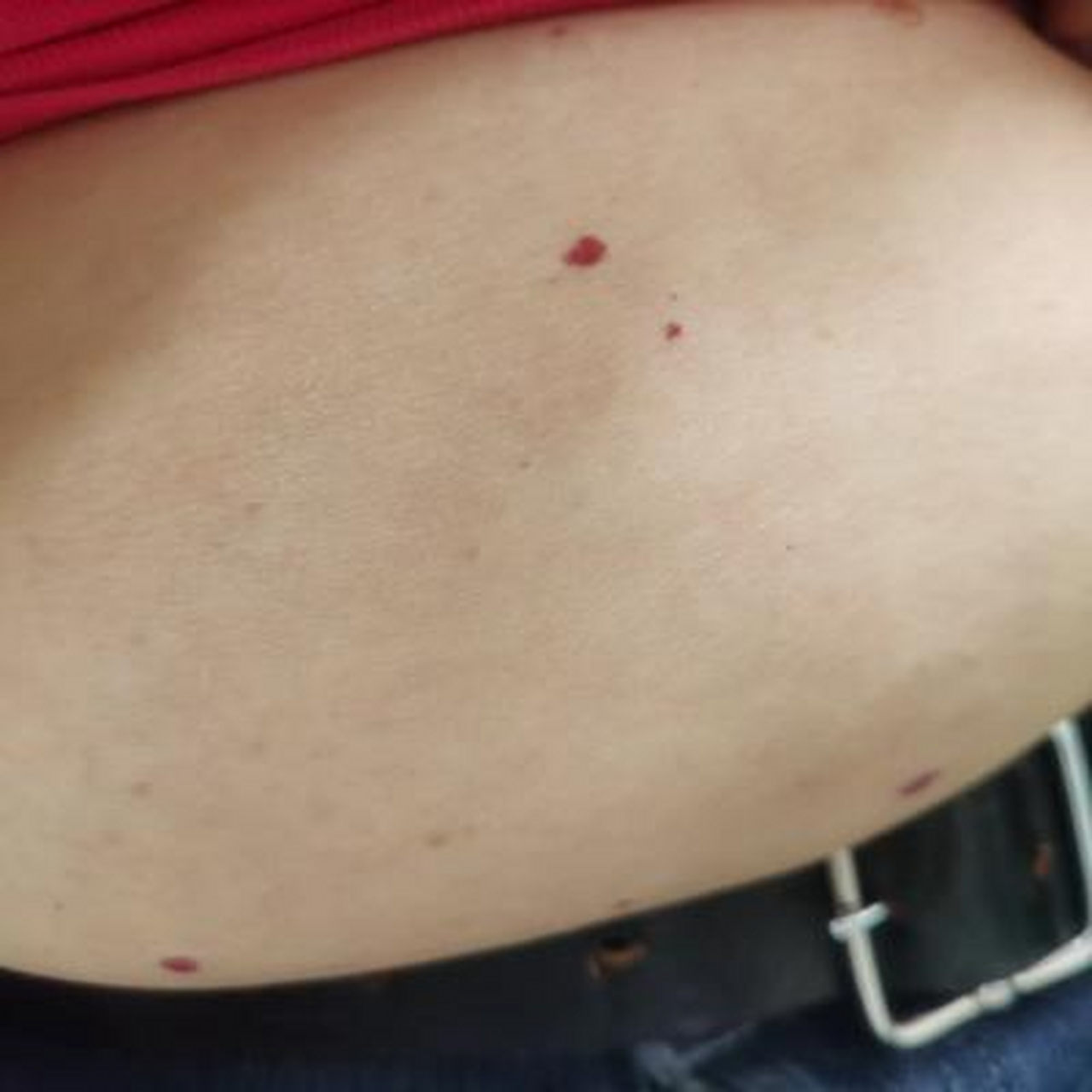 皮肤上出现很多小红痣,  胳膊上,肚子上都有,  有的朋友听说是因为肝