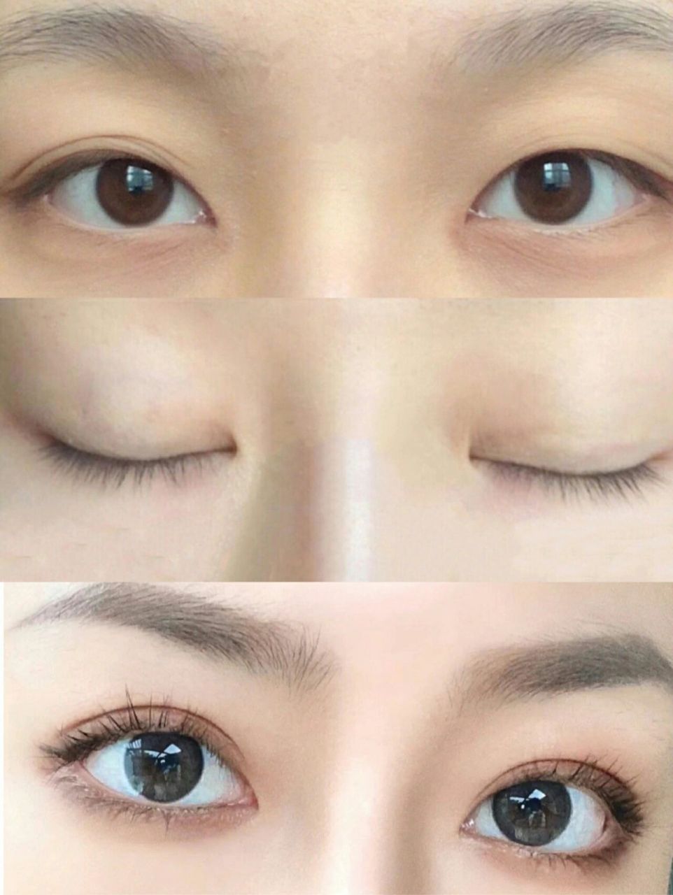 双眼皮埋线手术适用于上睑皮肤紧致,眼皮较薄,双眼之间距离合适以及