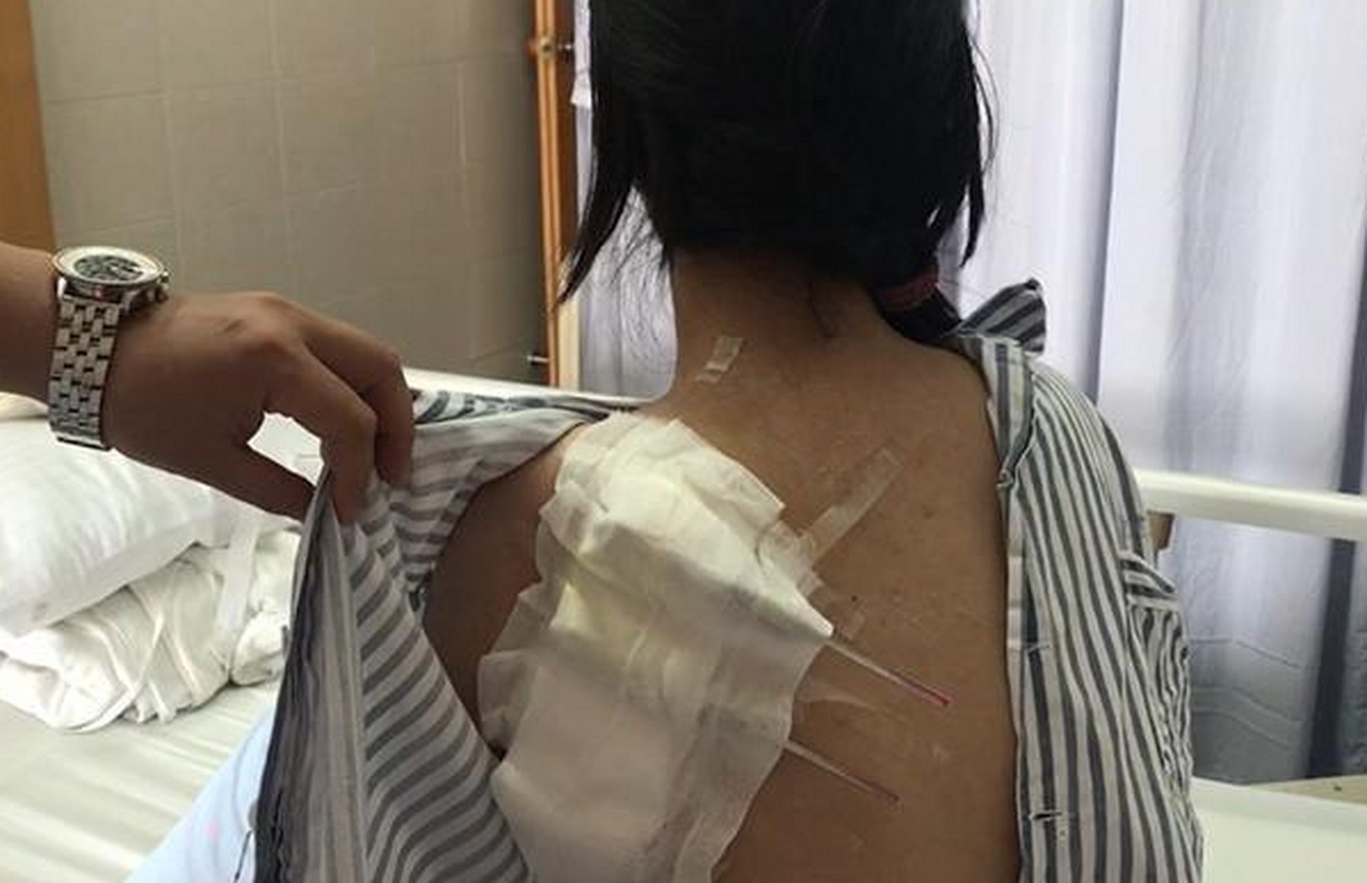 女子洗澡时,发现后背肿起一个"包块",医生说是脂肪