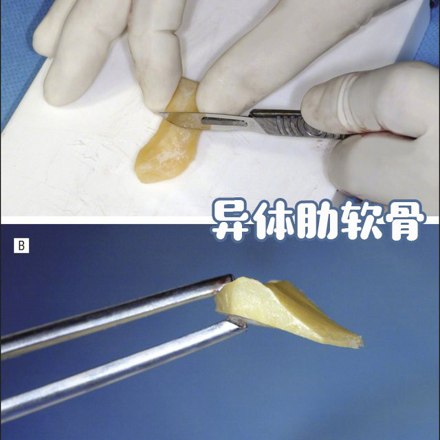 异体骨隆鼻图片