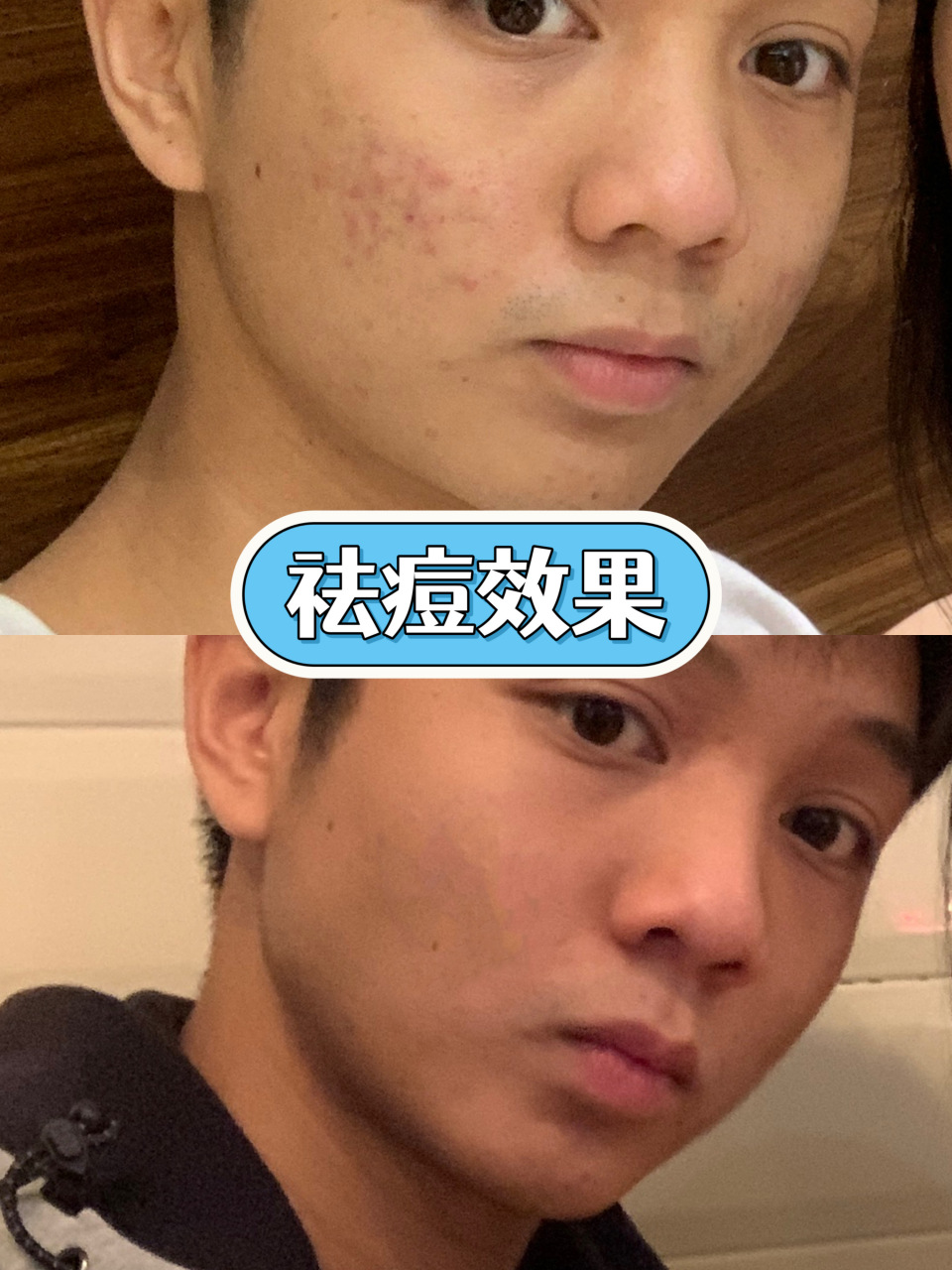 其实有一组祛痘cp,平价有效,它们就是红蓝光和针清!