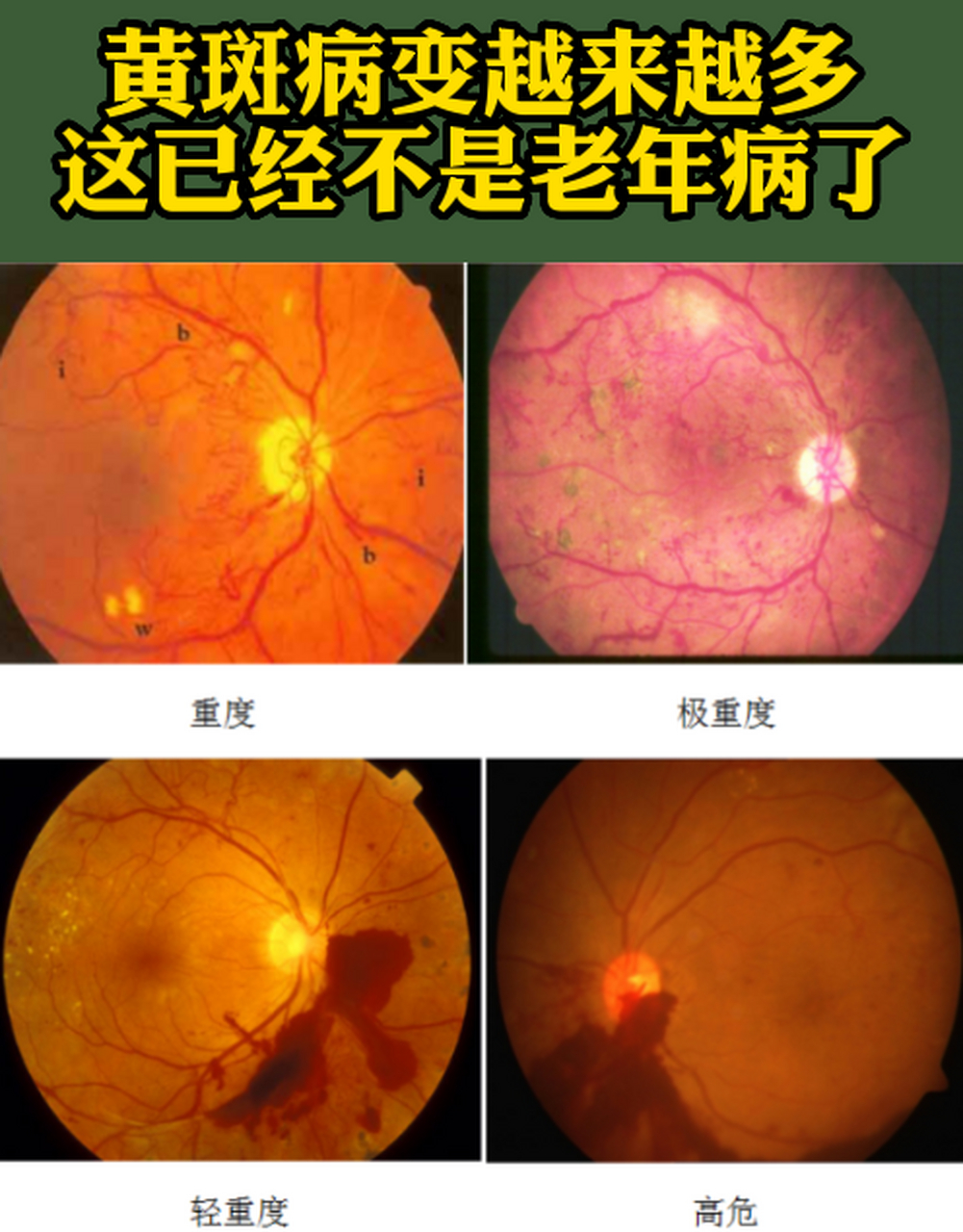 黄斑病变其实它是我们人体的一种眼部老化的疾病,但是由于现代人动眠
