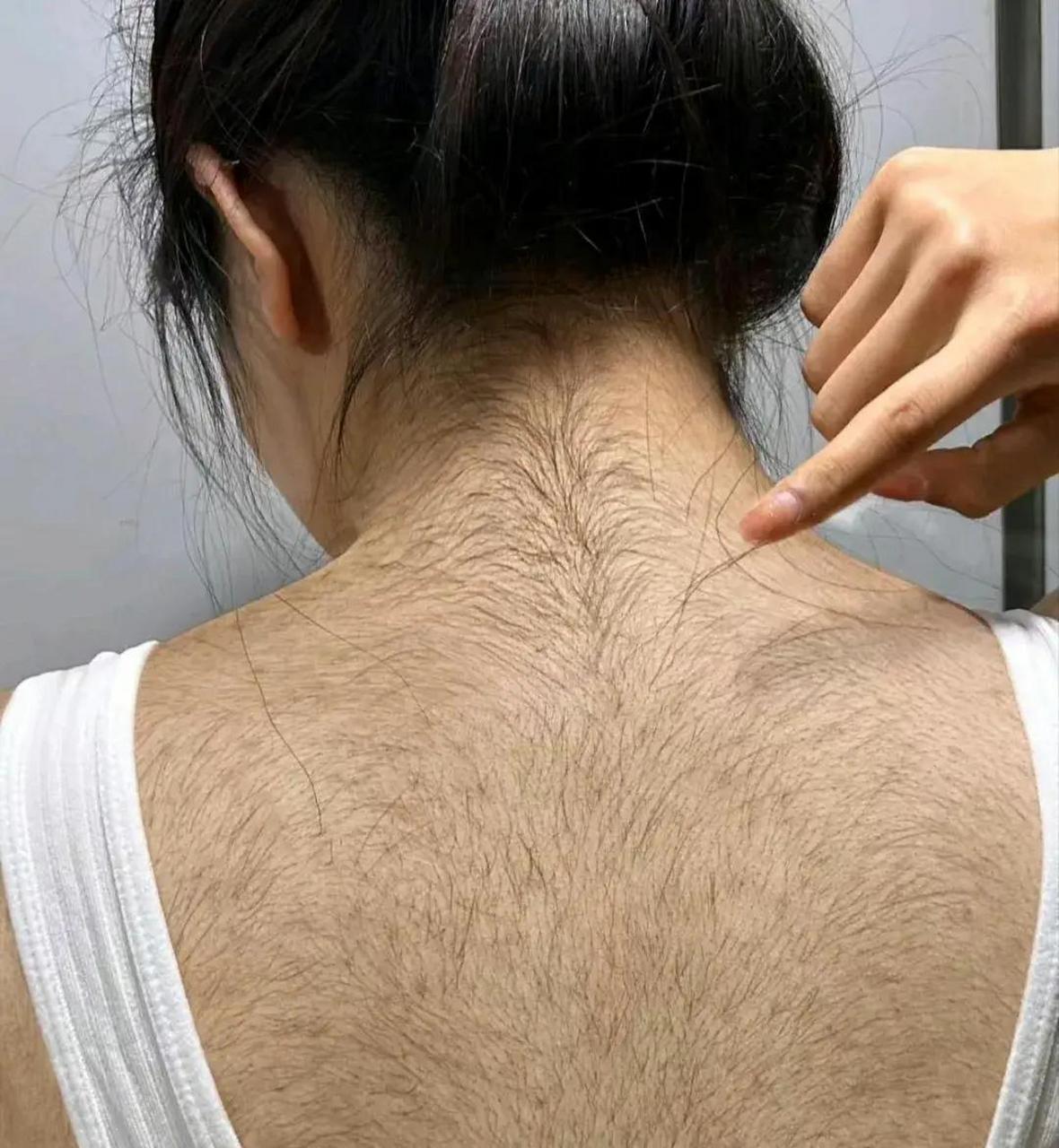 从青春期开始就汗毛旺盛,谈了三个男朋友都吓跑了,看了很多医院都没有