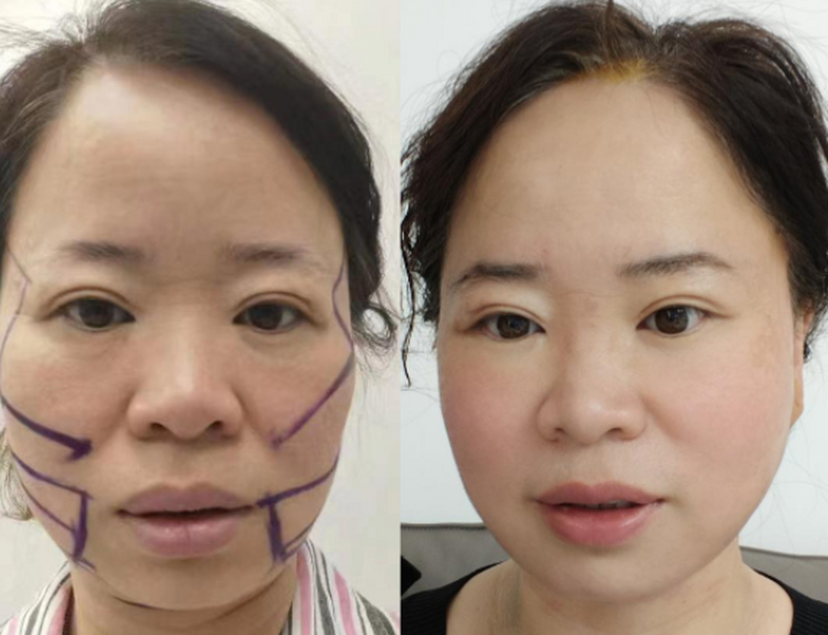 面部拉皮手术图片对比图片